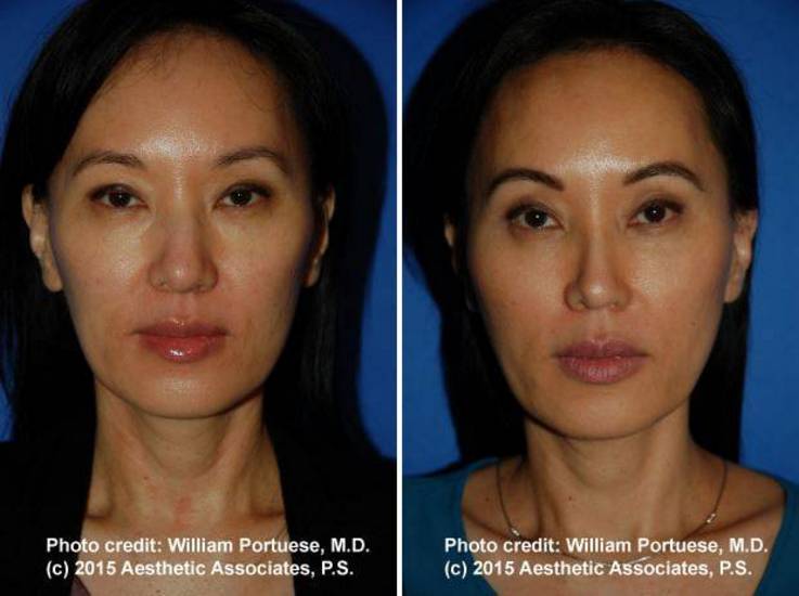 best rhinoplasty seattle